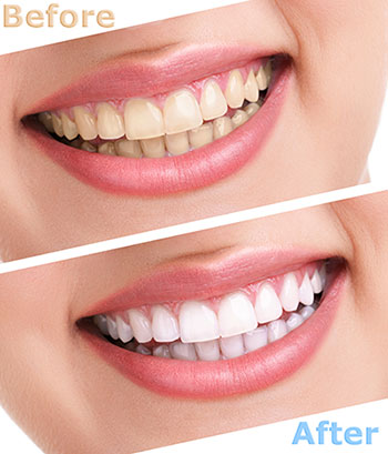 Alan Wolkoff, D.M.D. | Dental Bridges, Periodontal Treatment and Veneers